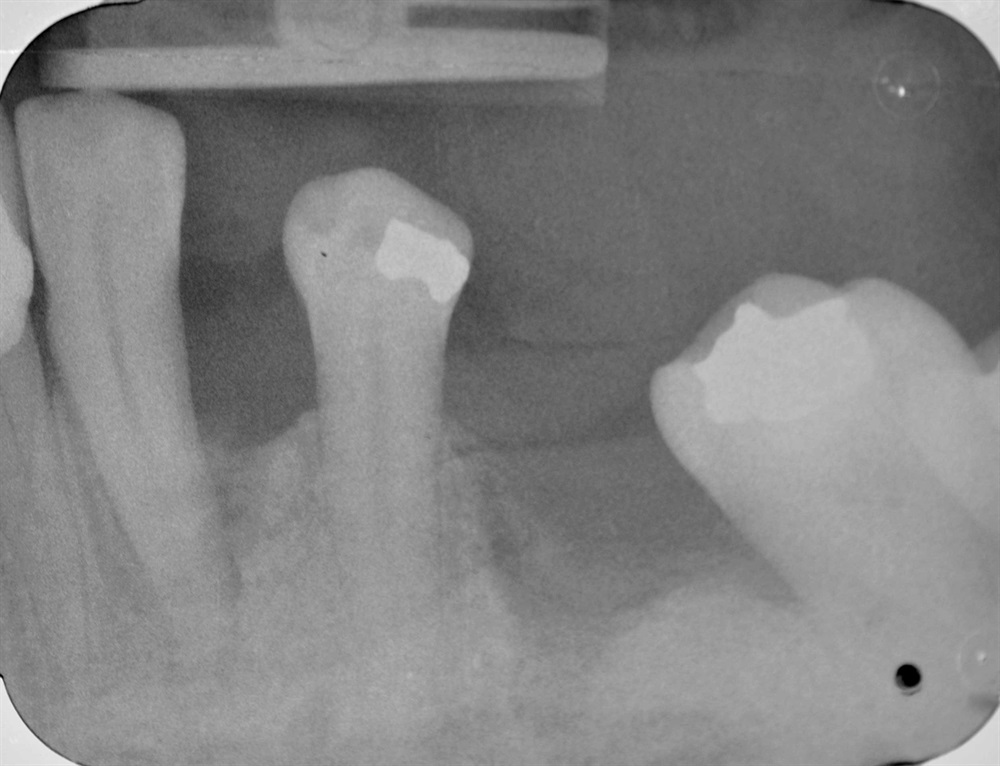 Tarquini_Periodontal intrabony defect